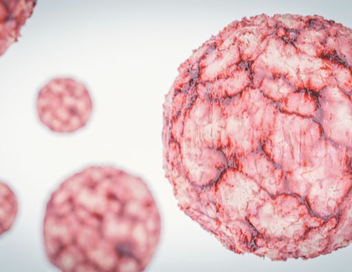 Kista Payudara, Kenali Gejalanya