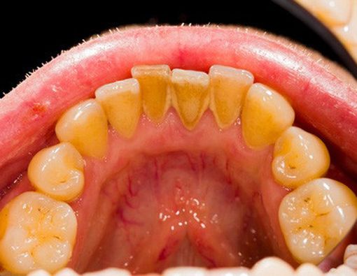 Jenis Zat Asam Penyebab Erosi Gigi