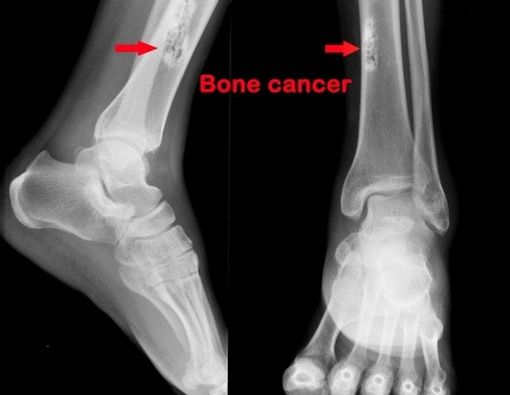 11 April: Hari Kanker Tulang