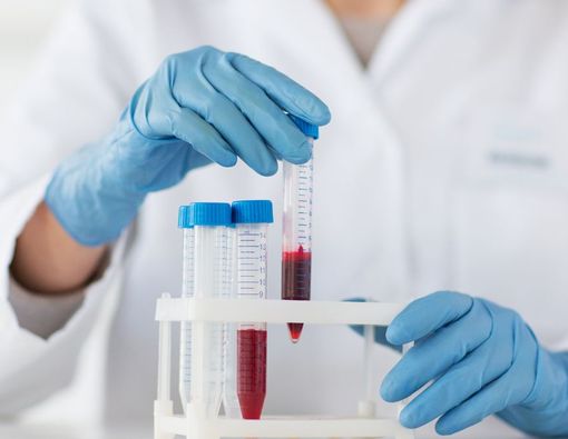 Kenali Tujuan Tes Kalsium Darah, Proses, dan Cara Baca Hasil Pemeriksaan