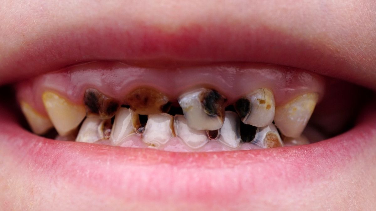 Cara Mencegah Gigi Busuk pada Anak