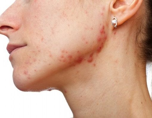 Mengenal Jerawat dan Penyebabnya