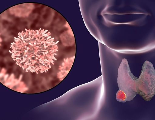 Mengenal Jenis-Jenis Pengobatan Kanker Tiroid