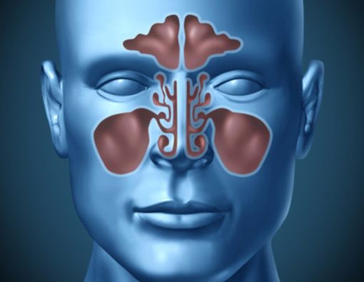 Sinusitis, Bisakah Disembuhkan?