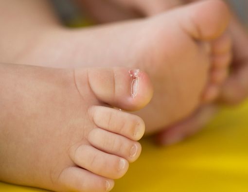 Kuku Cantengan pada Bayi, Atasi dengan Cara Ini