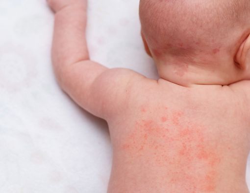 4 Masalah Kulit yang Rentan Terjadi pada Bayi