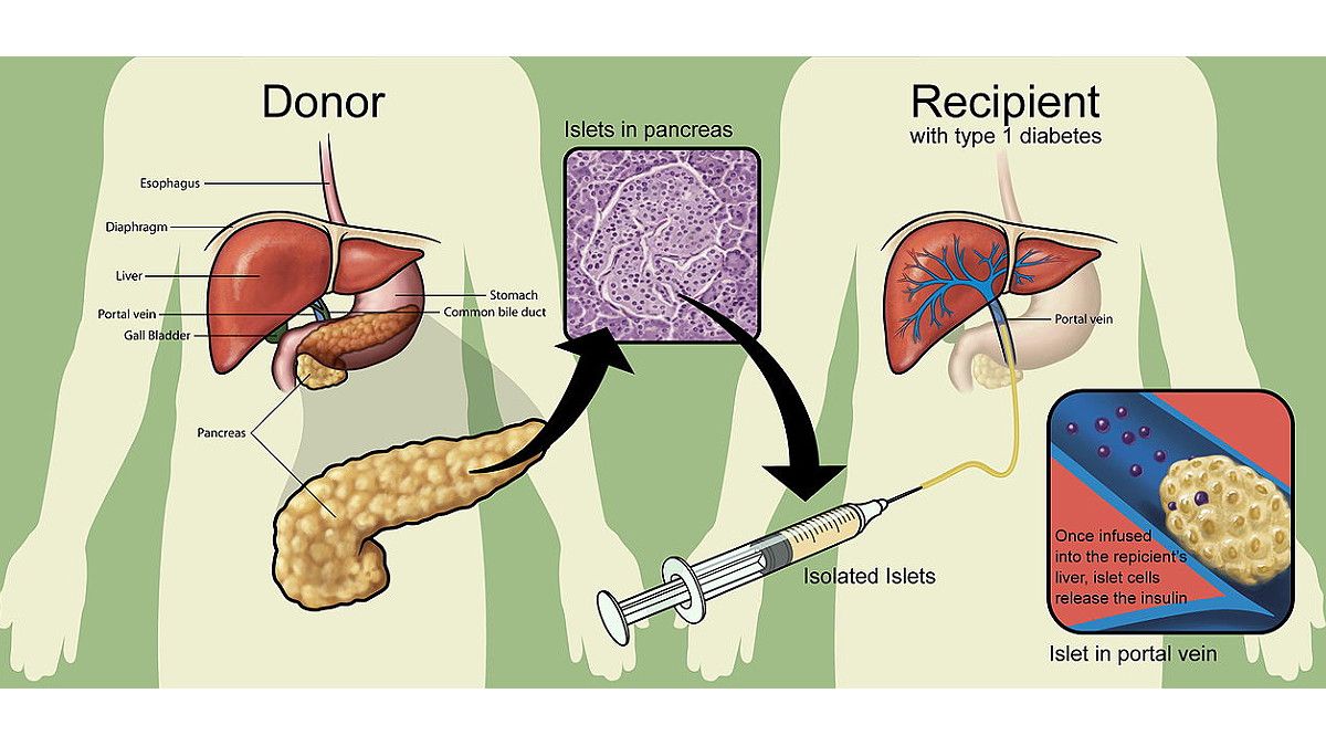Risiko Transplantasi Islet pada Pengobatan Diabetes Tipe 1
