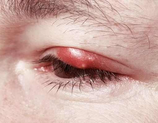 Inilah Penyebab Sebenarnya Mata Bisa Bintitan