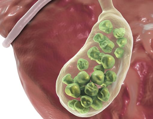 6 Penyebab Batu Empedu yang Perlu Diwaspada