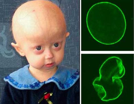 Penderita Progeria Kemungkinan Bisa Diobati