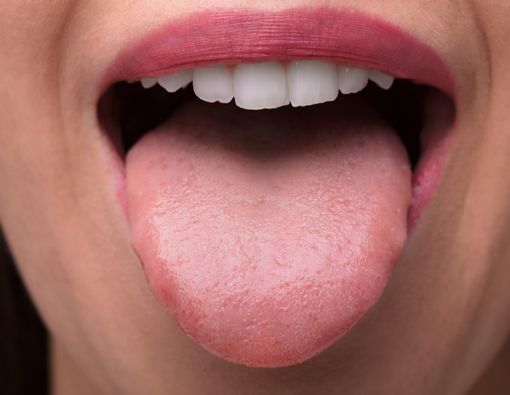 Perubahan Warna pada Lidah yang Tak Boleh Diabaikan