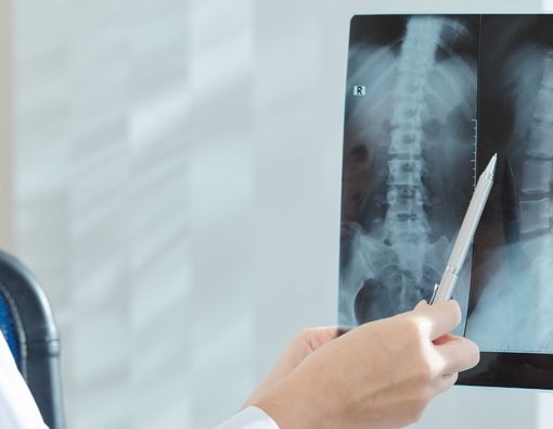 Vertebroplasty, Pengobatan Tulang Belakang Tanpa Operasi