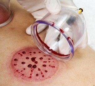 Baik dan Buruk Terapi Bekam Menurut Medis