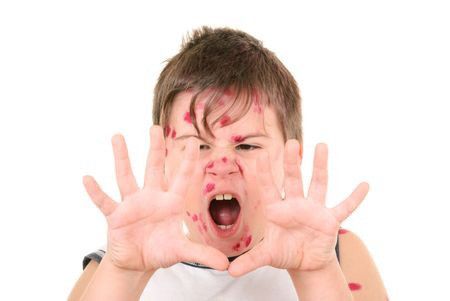 Tips Menghadapi Wabah Cacar Air di Sekolah Si Kecil