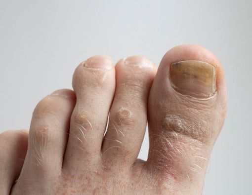 Kenali Nail Pitting, Penyebab Kuku Berlubang dan Bergelombang