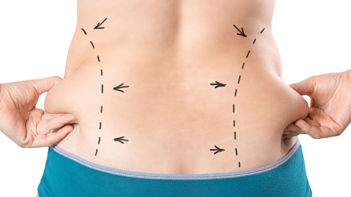 Fakta tentang Sedot Lemak, Cara Instan Hilangkan Lemak di Tubuh
