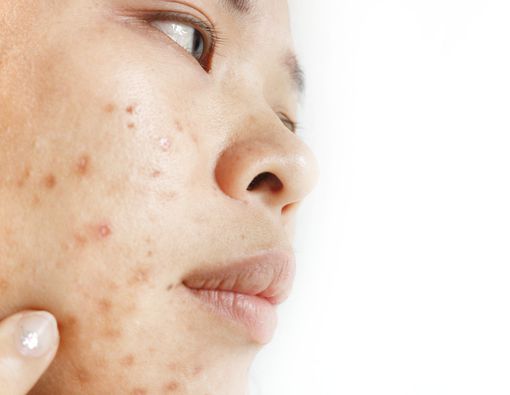 Kesalahan Pakai Skincare yang Bikin Kulit Jadi Jerawatan