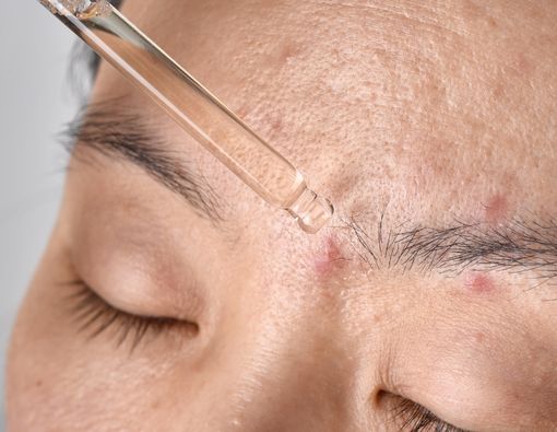 12 Serum Terbaik untuk Menghilangkan Bekas Jerawat di Wajah