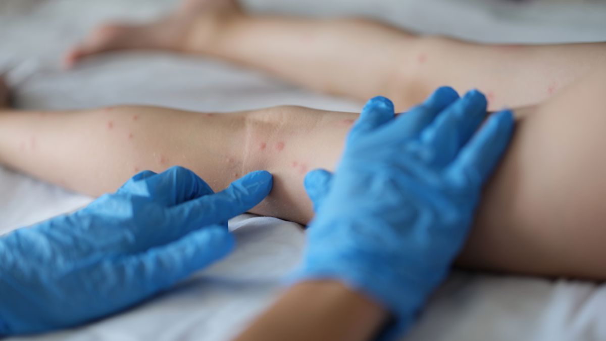 bintik-bintik merah di kaki 2