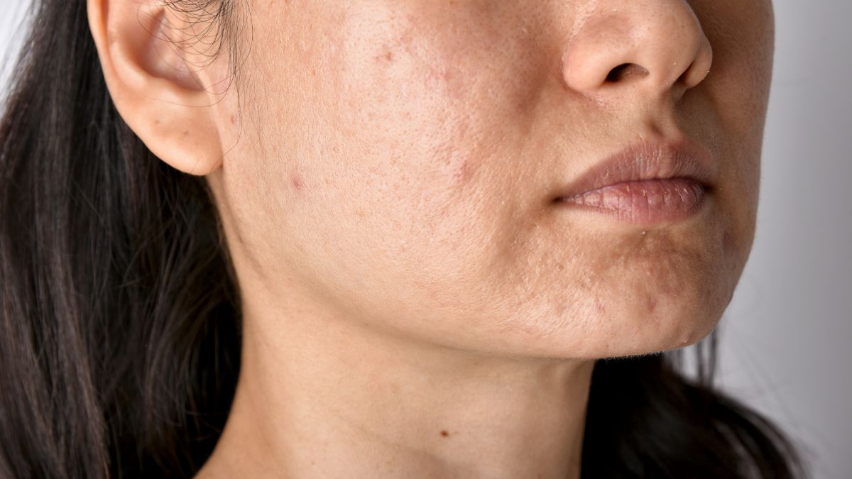 Penyebab Seseorang Memiliki Acne Prone Skin