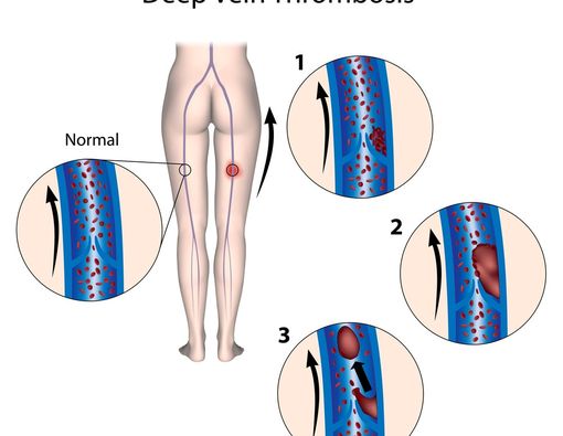 Berkenalan Lebih Jauh dengan DVT