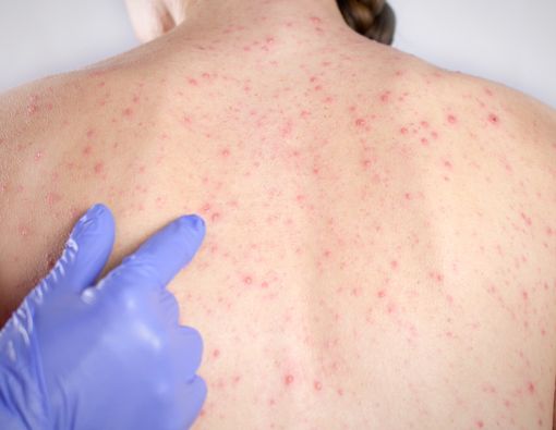 Tidak Tertular Campak padahal Satu Ruangan, Kok, Bisa?