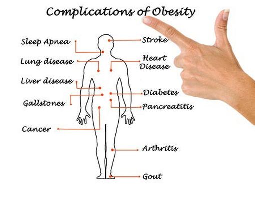Inilah yang Terjadi pada Tubuh  Apabila Mengalami Obesitas