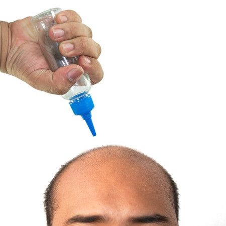 Perawatan untuk Kebotakan