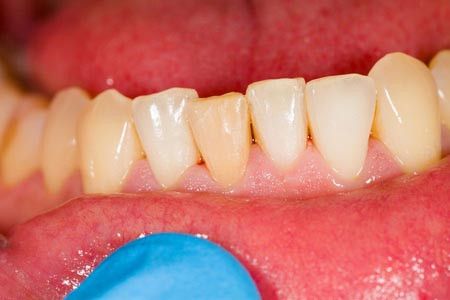 Apakah Penyebab dari Penyakit Gusi?