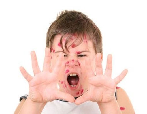 Tips Menghadapi Wabah Cacar Air di Sekolah Si Kecil