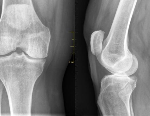 Jenis Tulang Rawan dan Kondisi Kesehatan yang Dapat Terjadi