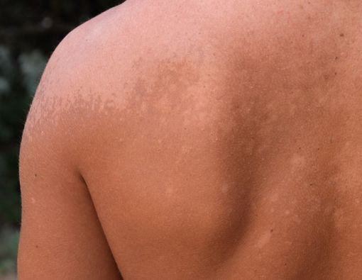 Yuk, Kenali Bakteri Penyebab Kusta