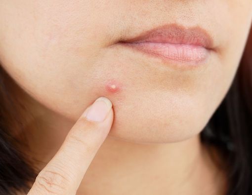 Penyebab Jerawat Sering Muncul di Tempat yang Sama