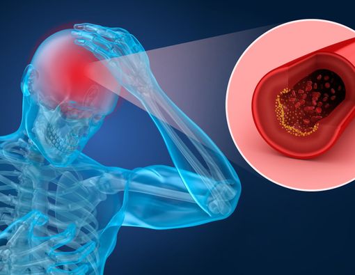 6 Komplikasi Stroke yang Perlu Anda Tahu