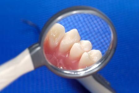 Mengenal Gingivitis