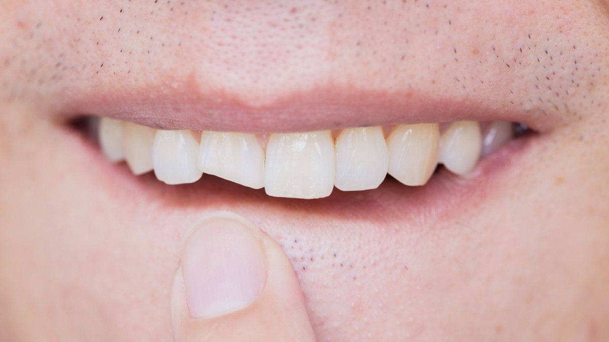 Gigi Retak atau Patah, Ini Cara Menanganinya