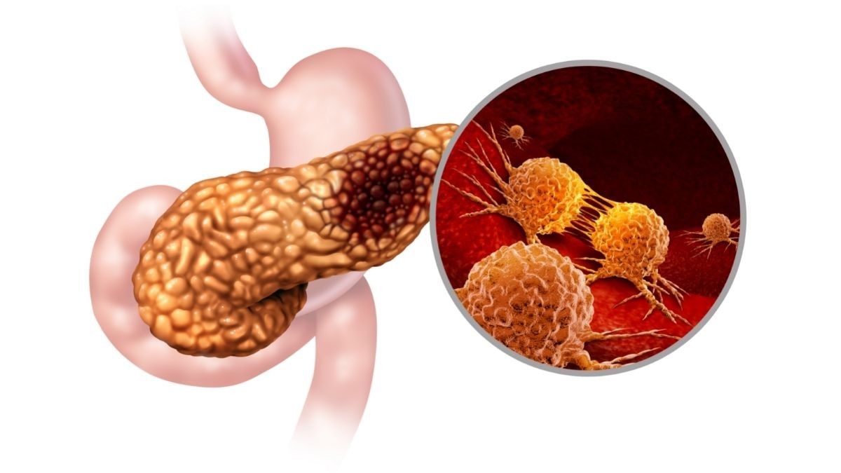 Operasi Whipple untuk Mengatasi Kanker Pankreas