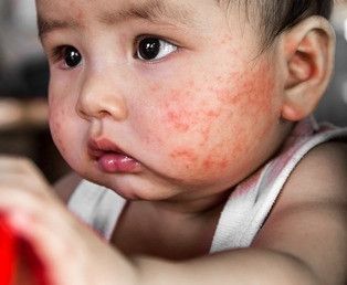 Kenali Ruam Merah pada Wajah Si Kecil