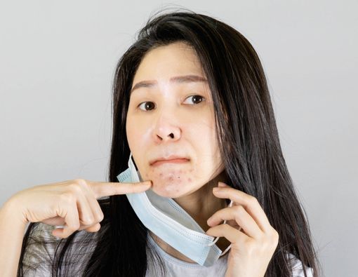 Hati-hati Maskne, Jerawatan karena Pakai Masker
