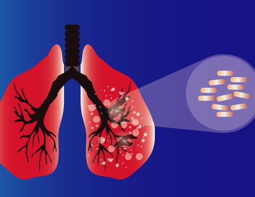 Mirip TB Paru, Ini Bedanya Penyakit Paru Interstisial