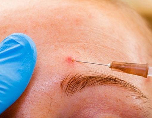 Penanganan Terkini untuk Jerawat Meradang