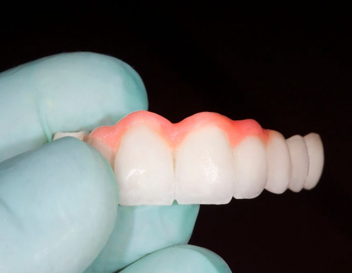 Mengenal Dental Bridge, Gigi Palsu Permanen yang Nyaman Digunakan