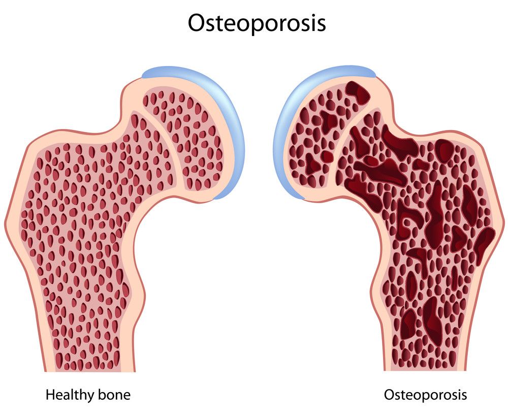 Wanita, Cegah Osteoporosis dengan Olahraga Ini