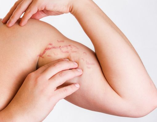 Cara Mudah Mencegah Stretch Mark