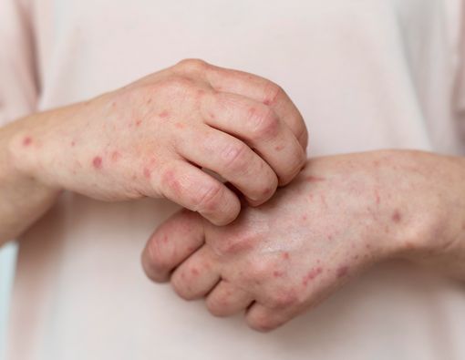 Bahaya Flu Singapura pada Anak Balita yang Sering Diabaikan Orang Tua