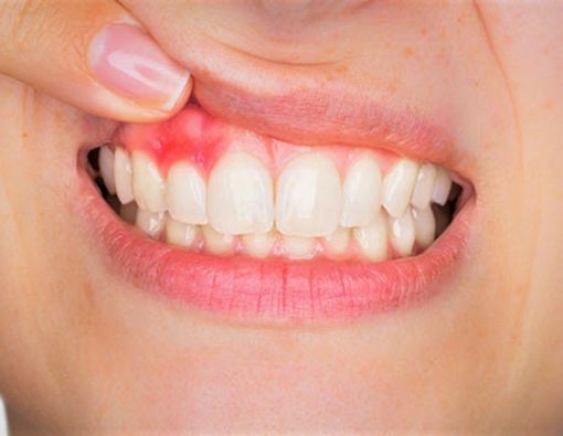 13 Penyebab Gusi Bengkak dan Cara Mengatasinya