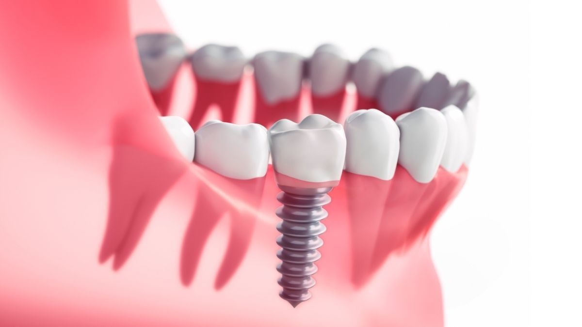 Komplikasi Implan Gigi yang perlu Anda Waspadai