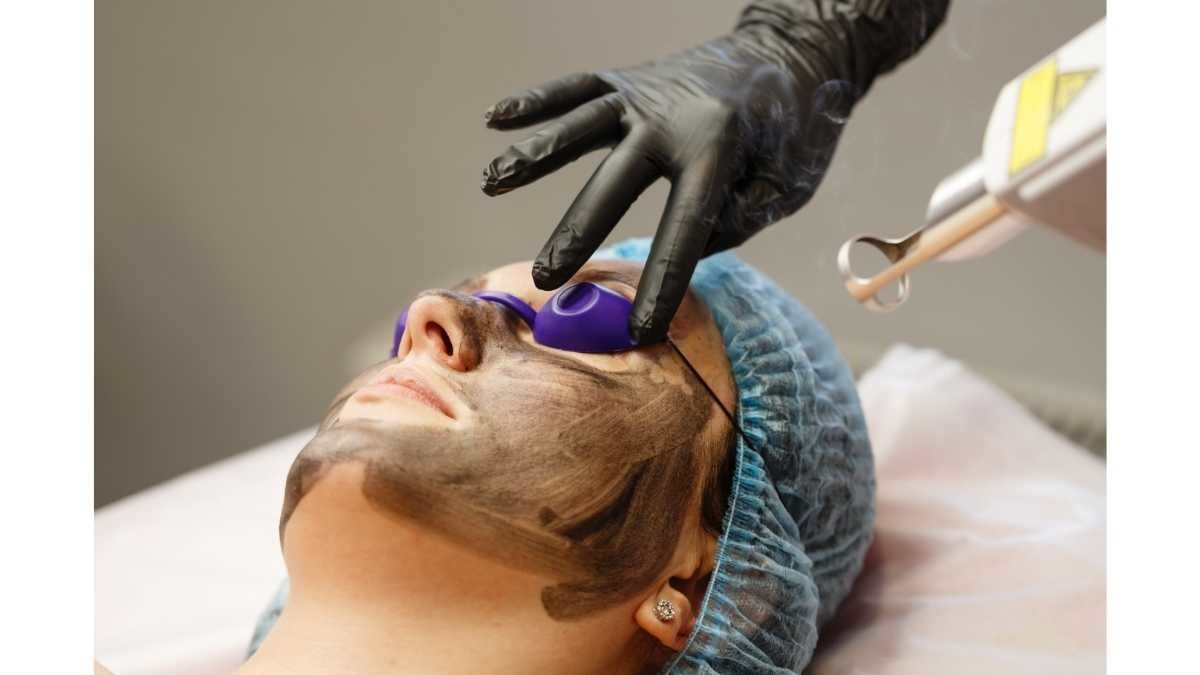 Mengenal Perawatan dan Manfaat Hollywood Laser Peel