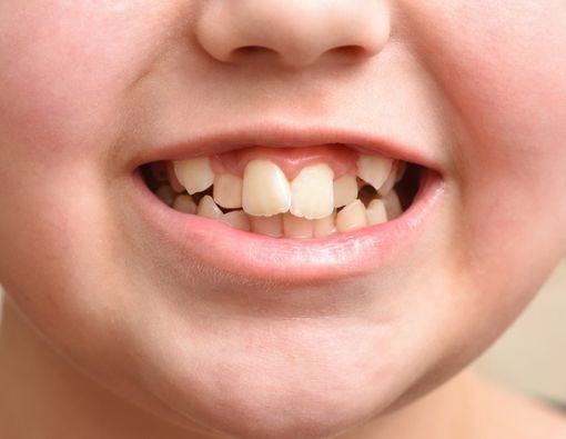Kenali Ciri-Ciri Gigi Gingsul pada Anak, Bisakah Dicegah?