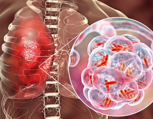 Fakta Tentang Pneumonia yang Perlu Kamu Tahu
